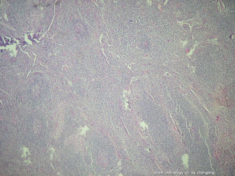 左颈淋巴结肿大（会1133）－单核样B细胞增生图5