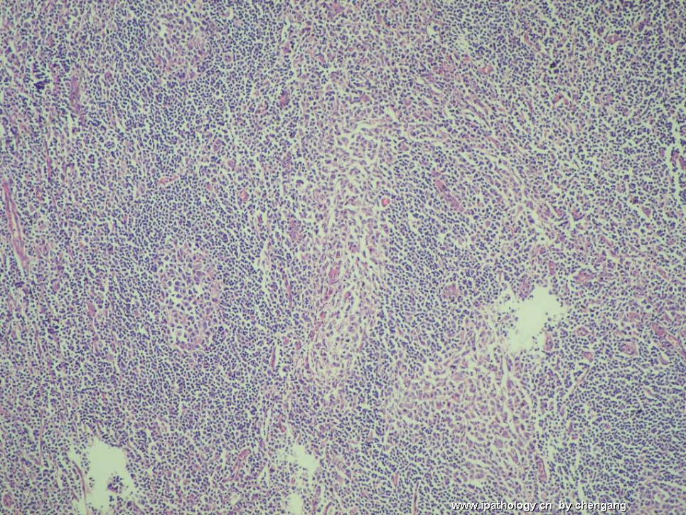左颈淋巴结肿大（会1133）－单核样B细胞增生图6