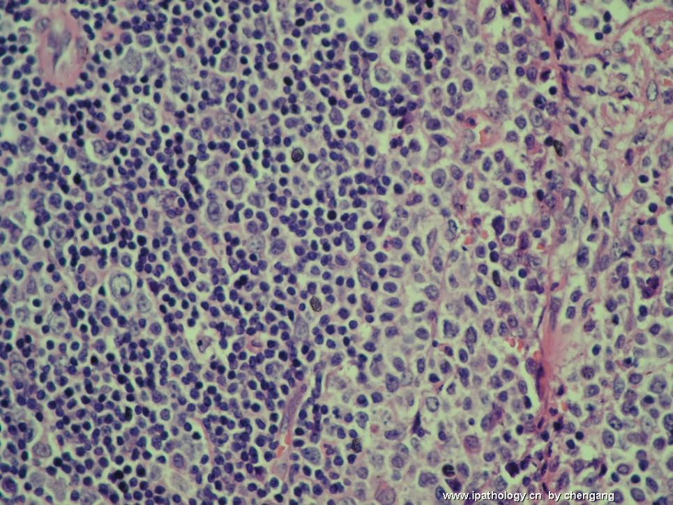 左颈淋巴结肿大（会1133）－单核样B细胞增生图9