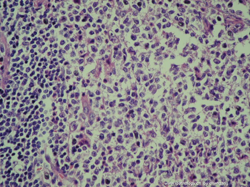 左颈淋巴结肿大（会1133）－单核样B细胞增生图12