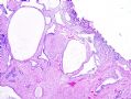 [已确证] 膀咣肿物：宫颈腺体异位 endocervicosis图2