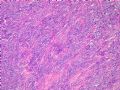 头顶肿物（会1022）-浆细胞瘤图2