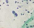 53岁，绝经，宫颈糜烂，接触性出血。传统涂片，细胞量少。图3