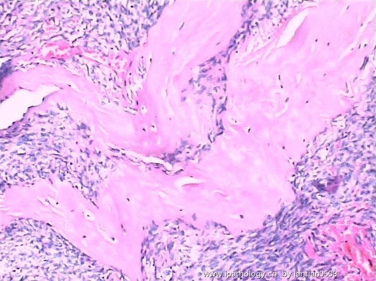 五十年病史的骨肉瘤？图6