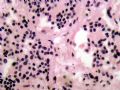乳房癌肿周围的细胞是什么?图5