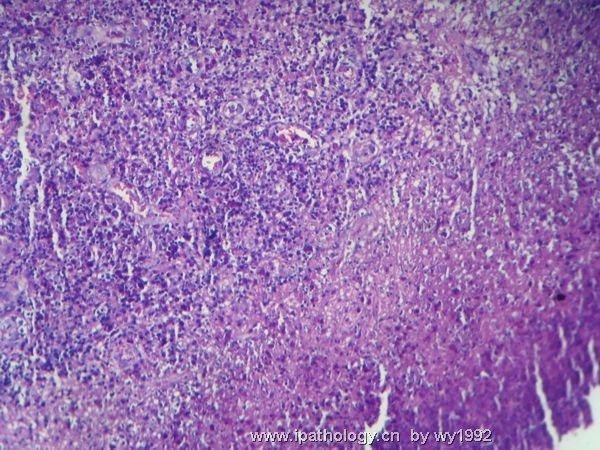 07324tumor hospital鼻腔新生物图2