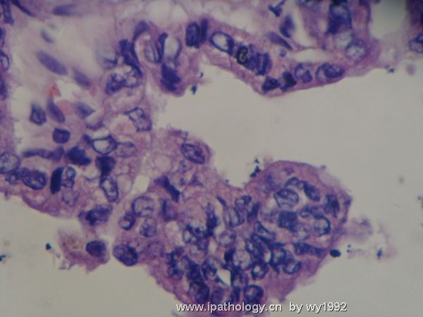 甲状腺肿快0805064图7