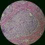 临床诊断乳腺癌（51岁）1368图5