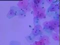 宫颈液基细胞 灰蓝色小体是什么 当时ASC-H发报告，活检无异常图1