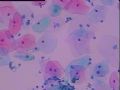 宫颈液基细胞 灰蓝色小体是什么 当时ASC-H发报告，活检无异常图4