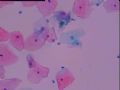 宫颈液基细胞 灰蓝色小体是什么 当时ASC-H发报告，活检无异常图6