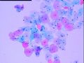 宫颈液基细胞 灰蓝色小体是什么 当时ASC-H发报告，活检无异常图9