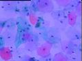 宫颈液基细胞 灰蓝色小体是什么 当时ASC-H发报告，活检无异常图10