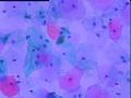 宫颈液基细胞 灰蓝色小体是什么 当时ASC-H发报告，活检无异常图11