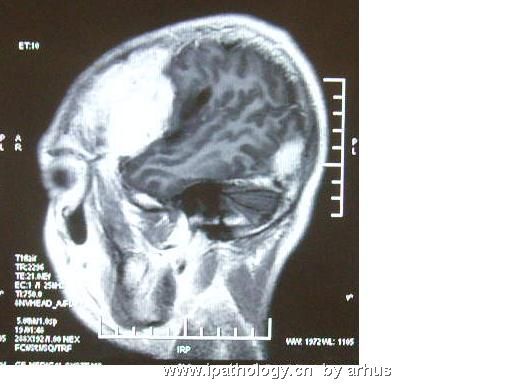 额颞部肿物－会2573图1