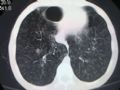 经典病例，肺部弥漫性病变图3