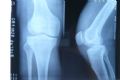 求助：右膝关节骨破坏图1
