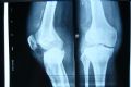 求助：右膝关节骨破坏图2
