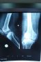 求助：右膝关节骨破坏图3