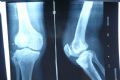 求助：右膝关节骨破坏图4