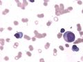原发性巨球蛋白血症图4