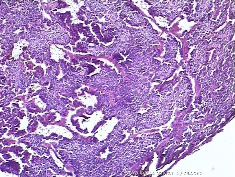 松果体肿瘤图1