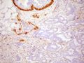 乳腺癌分类--接续乳腺肿物1的HE及IHC图4
