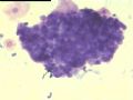看看我们科室的痰液基细胞学图2