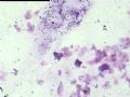 看看我们科室的痰液基细胞学图5