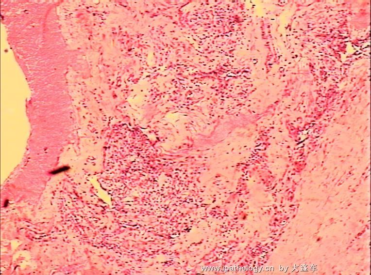 直肠疝内赘生物  08-6064图1