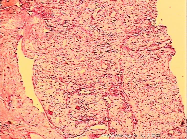 直肠疝内赘生物  08-6064图5