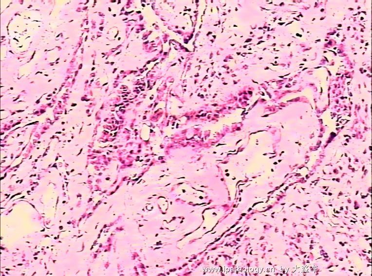 直肠疝内赘生物  08-6064图11