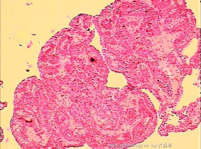膀胱新生物 08-21354图6