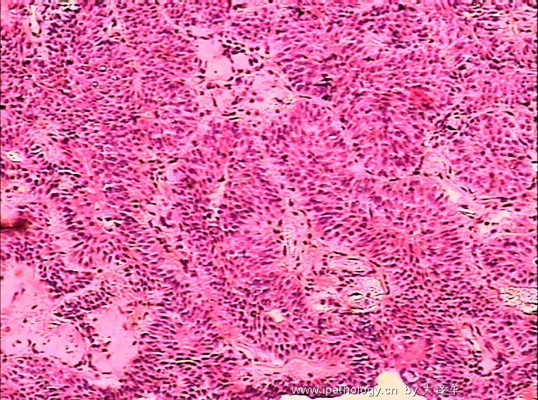 膀胱新生物 08-21354图7