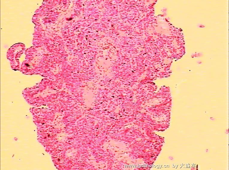 膀胱新生物 08-21354图11