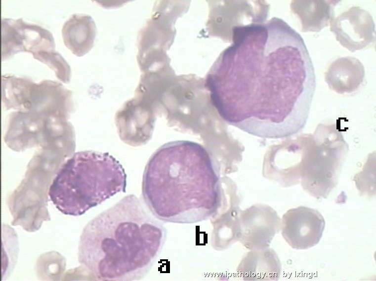 白血病外周血细胞形态图1