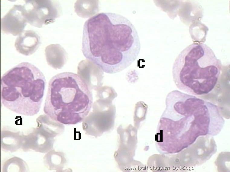 白血病外周血细胞形态图2