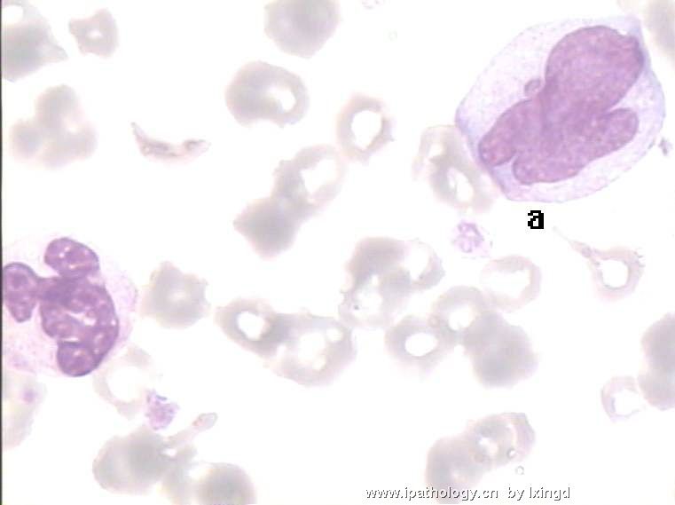 白血病外周血细胞形态图5