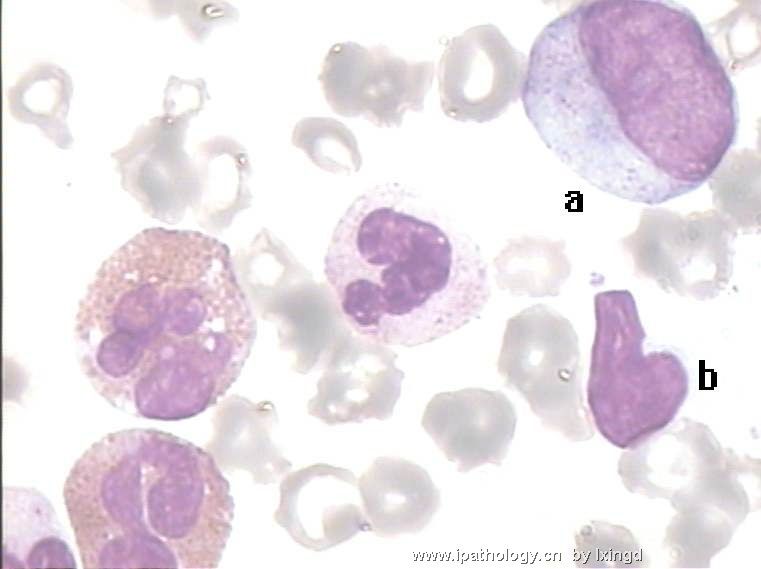 白血病外周血细胞形态图6
