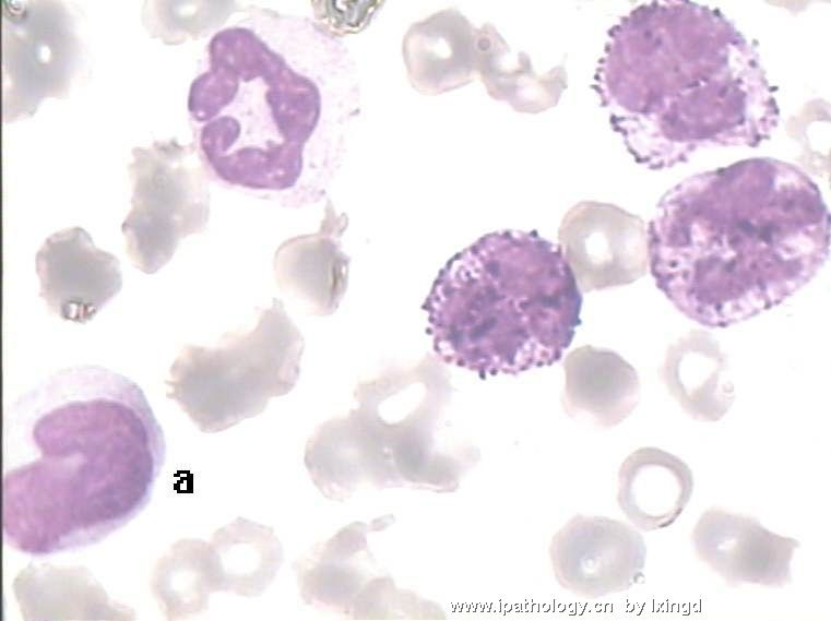 白血病外周血细胞形态图7