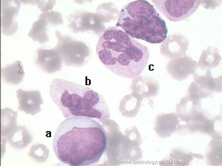 白血病外周血细胞形态图8