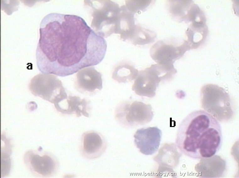 白血病外周血细胞形态图9