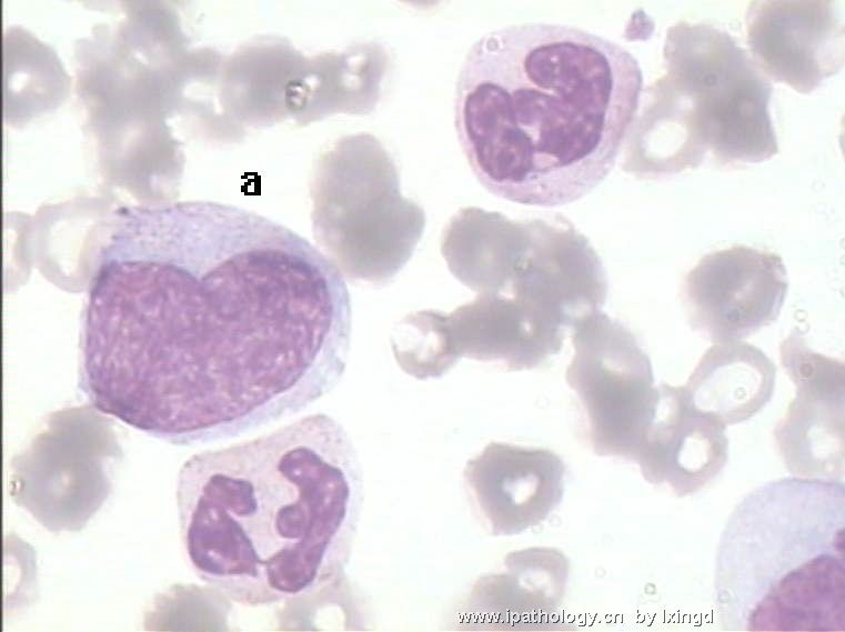 白血病外周血细胞形态图10