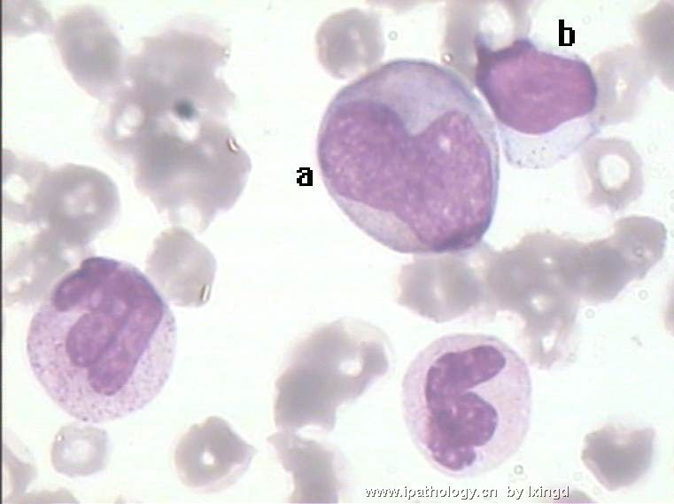 白血病外周血细胞形态图11