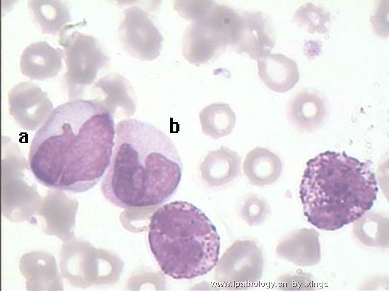 白血病外周血细胞形态图12