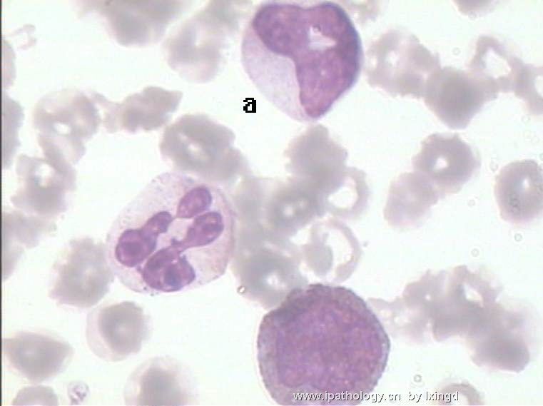 白血病外周血细胞形态图13