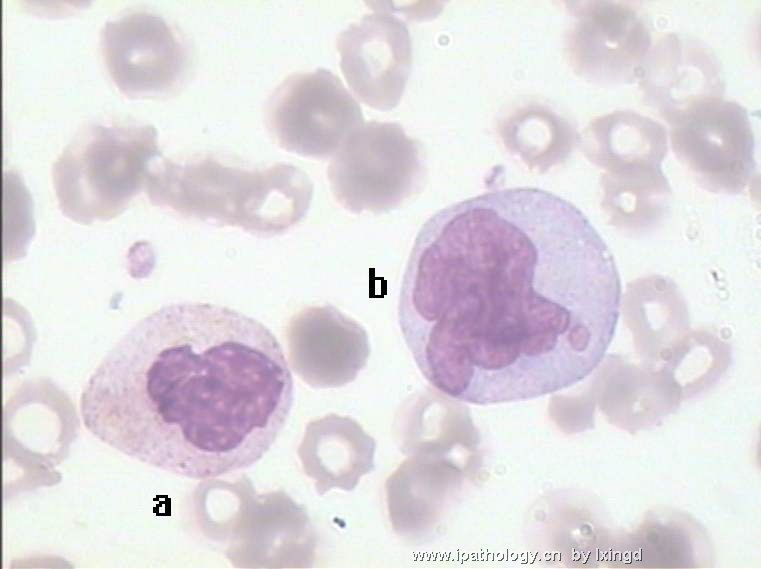 白血病外周血细胞形态图14
