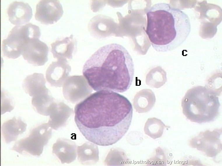 白血病外周血细胞形态图15