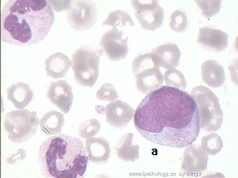 白血病外周血细胞形态图16