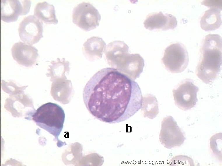 白血病外周血细胞形态图17